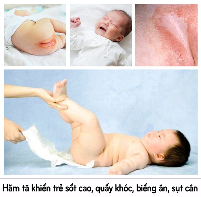 8 bài thuốc dân gian chữa hăm tã cho bé " nhàn tênh"