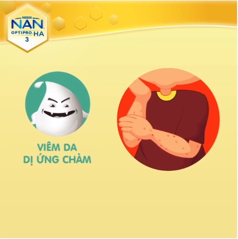 Viêm đại ứng chàm ở trẻ nhỏ
