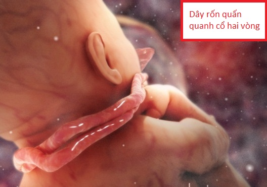 Dây rốn quấn cổ 2 vòng