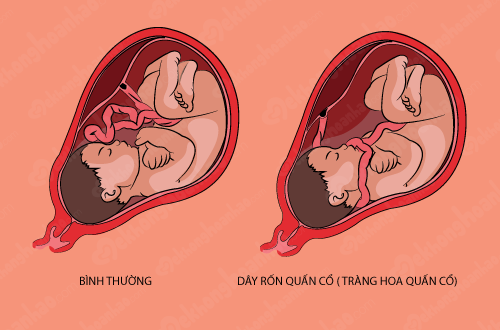Dây rốn quấn cổ