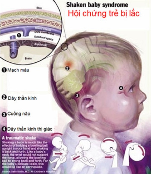 Nguy hiểm khôn lường từ hội chứng rung lắc trẻ