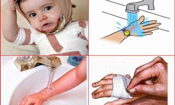 Cách sơ cứu khi trẻ bị bỏng