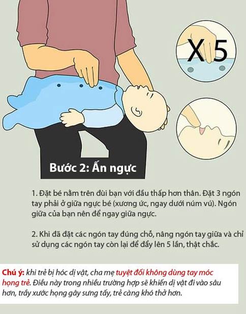 Mách mẹ cách sơ cưu skhi trẻ hóc dị vật